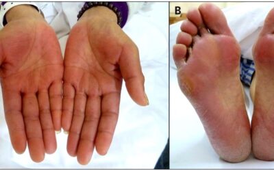 Thank you 2 Care For Hand-Foot Syndrome (HFS)